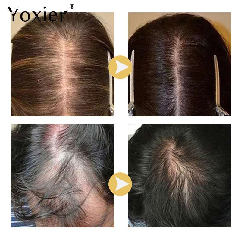 سيروم نمو مكثف يمنع تساقط الشع - مراجعة Hair Care Treatment وسعره